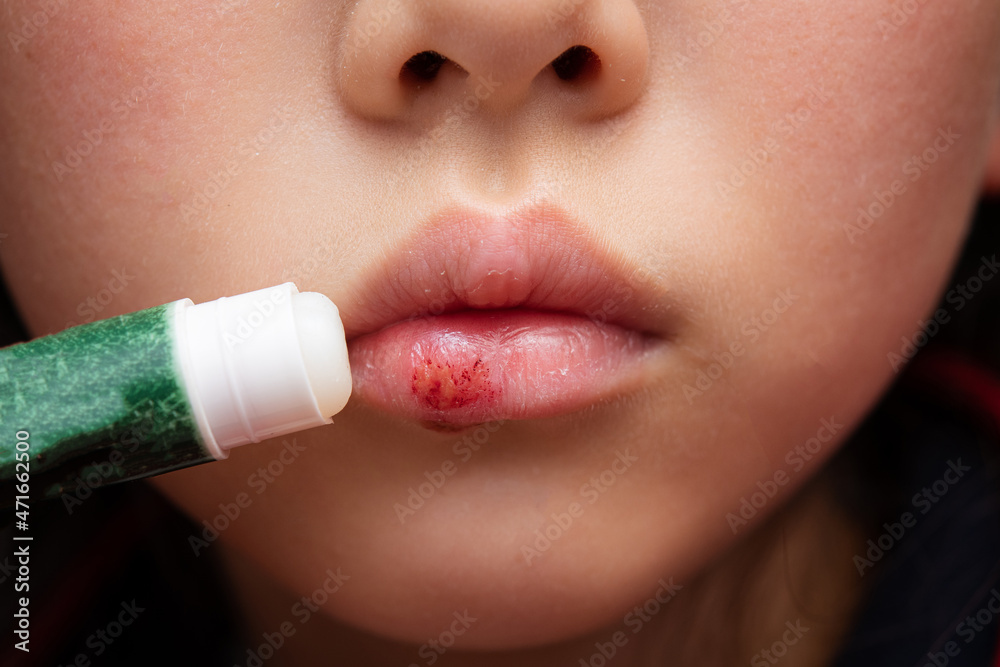 荒れた唇にリップクリームを塗る子供 Stock Photo Adobe Stock