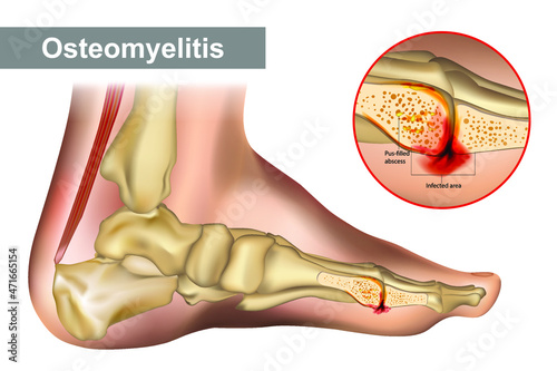 Osteomyelitis is an infection of bone. Diagram shows osteomyelitis of a humans foot bone. Necrotic bone