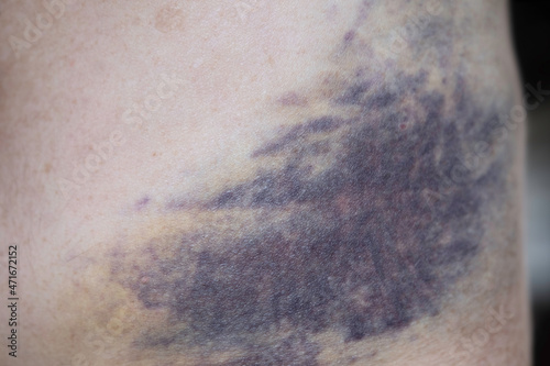 Subcutaneous bruising or hematoma on the side of a human's lower abdomen