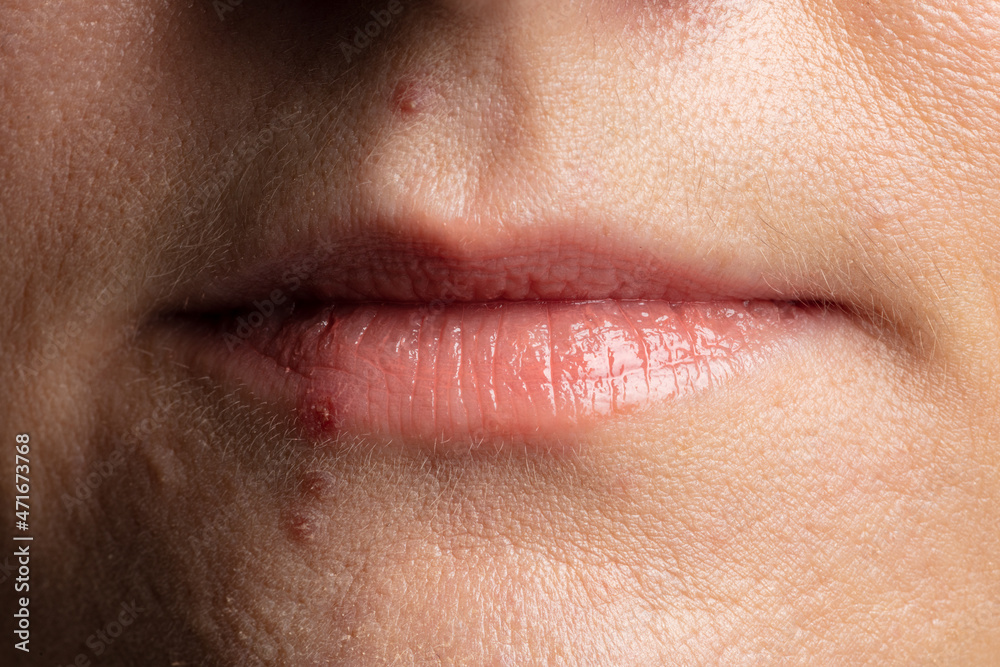 Fototapeta premium human lips close up with pimples on the face