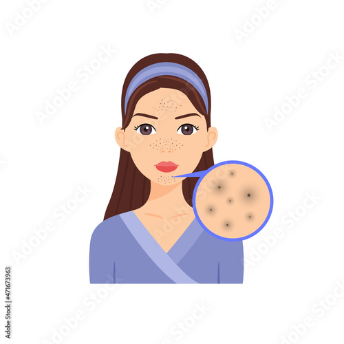Portrait of Beautiful Young Woman with Blackheads on Face. Diagnosis and Analysis of Teenage Skin. Zoom. Flat Color Cartoon Style. White background. Illustration for Cosmetology, Beauty Design. Vector