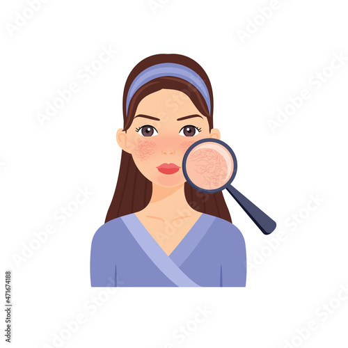 Rosacea. Couperose on Female Face. Dilated Capillaries and Beautiful Woman. Magnifying Glass and a Close Up of Problem Skin. Diagnosis. Cartoon style. Illustration for Beauty, Medical design. Vector.