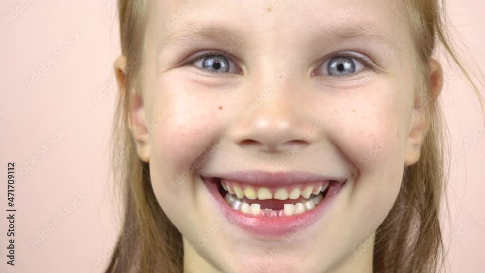 Close-up of the face of a little girl who shows her mouth with fallen milk teeth, grimaces. Close-up of the face of a little girl who shows her mouth with fallen milk teeth, grimaces.