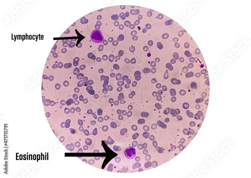 Blood smear view of under microscope, complete blood count for treatment, eosinophil and lymphocyte, magnification 100x, focus view photo