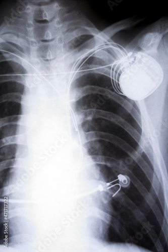 x-ray imagefrom the human chest and pacemaker photo