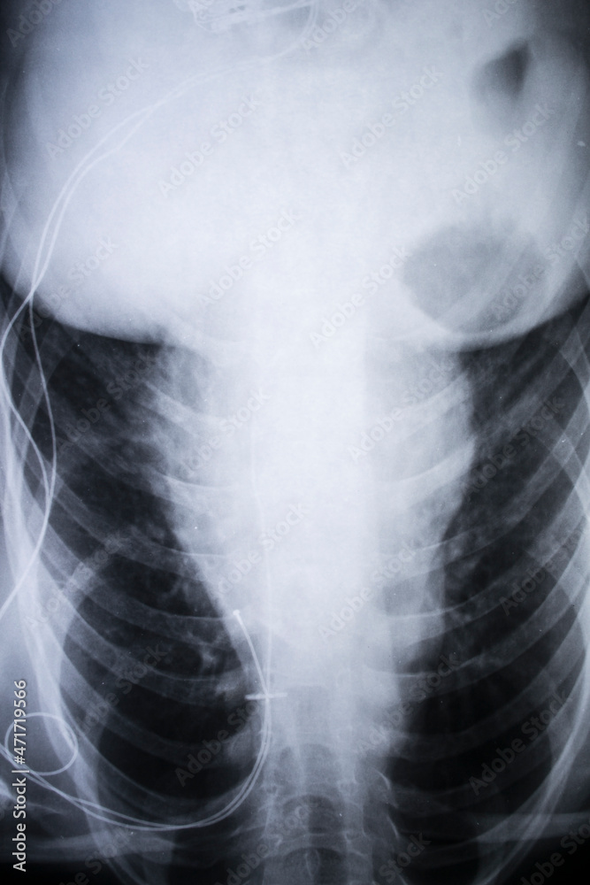 x-ray imagefrom the human chest and pacemaker x-ray imagefrom the human chest and pacemaker