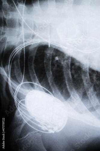 x-ray imagefrom the human chest and pacemaker photo