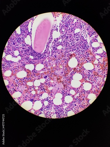 Bone marrow biopsy H and E stain showing eosinophilia photo