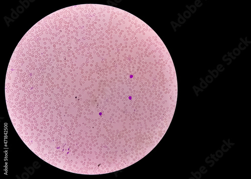 Abnormal microscopic view of hematological slide. Hemoglobin E (HbE) disease photo