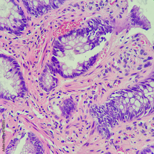 Camera photo of colonic mucosa, showing ulcer with muscular fibers in lamina propria. Solitary rectal ulcer syndrome is suggestive. Magnification 400x, photograph through a microscope