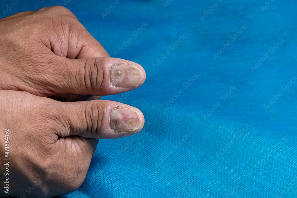 Fotografie Males thumbs with fungal nail infection. Medical themes.
