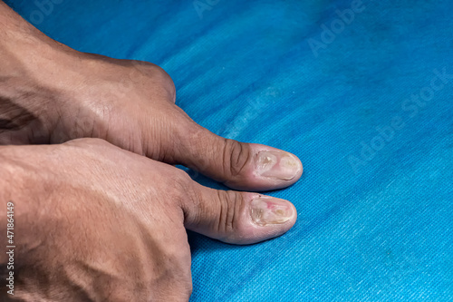 Males thumbs with fungal nail infection. Medical themes. photo
