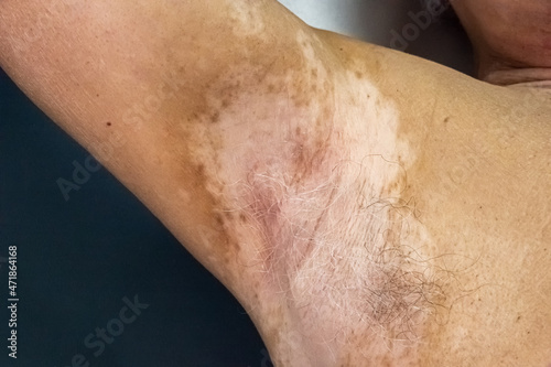 Man with vitiligo disease on his armpit. Medical themes