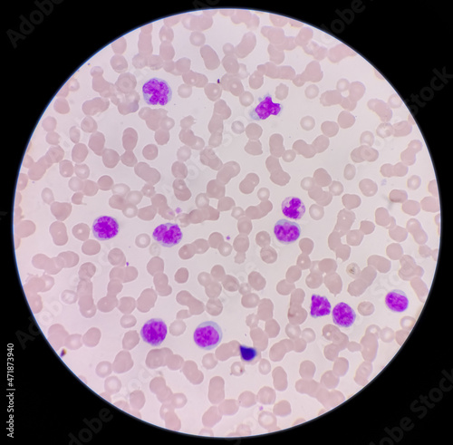 Microscopic image showing thrombocytopenia with leukocytosis, monocytes and myelocytes increased, myeloproliferative disorder. photo
