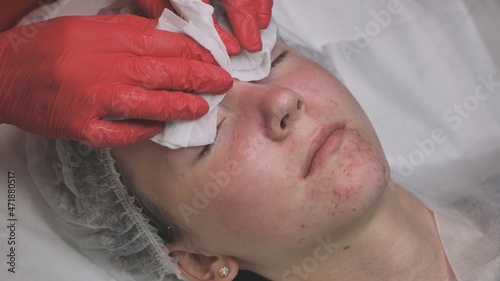 Wipe the mask off the face of a girl with problematic koja with cotton pads. photo