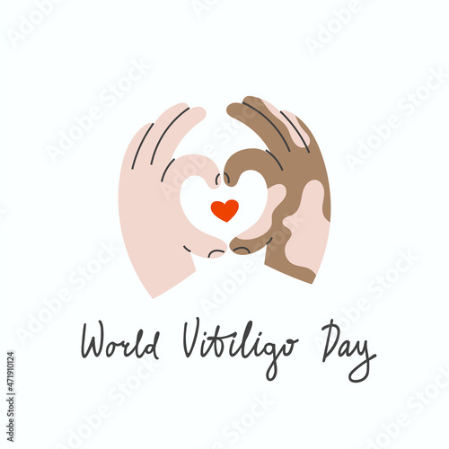 Swarthy hands with vitiligo make a heart shape gesture