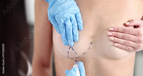 Gloved plastic surgeon drawing preoperative markings on patient chest closeup 4k movie slow motion photo