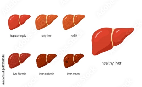 Liver diseases concept in flat style, vector photo