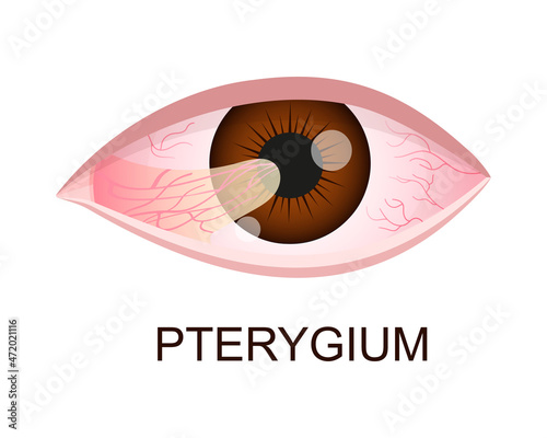 Pterygium growing onto the cornea. Conjunctival degeneration. Eye disease. Human organ of vision with pathology. Vector realistic illustration. photo