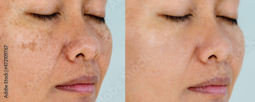 Image before and after spot melasma pigmentation facial treatment on asian woman face. skincare and health problem concept. 