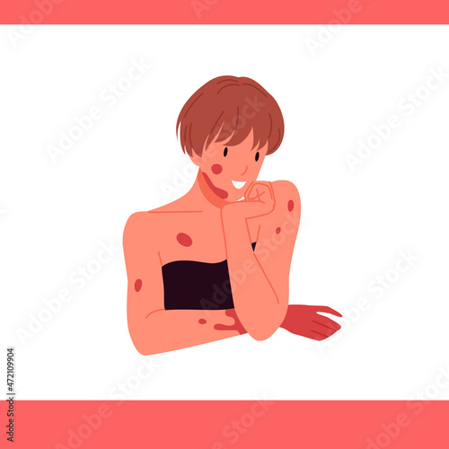 Woman with melasma, dark brown pigment spots on skin of face and body vector illustration. Cartoon girl with hyperpigmentation, freckles and cosmetic problems. Dermatology, cosmetology concept