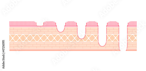 Stages of gastric ulcer ( stomach ulser ) vector illustration