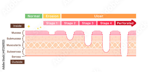 Stages of gastric ulcer ( stomach ulser ) vector illustration photo