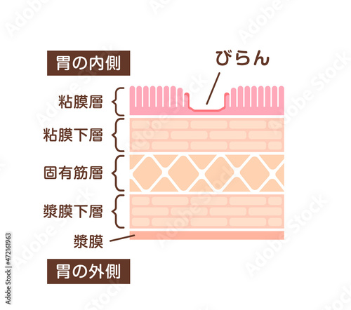 胃壁の断面図イラスト / 胃潰瘍の初期症状 (びらん) 