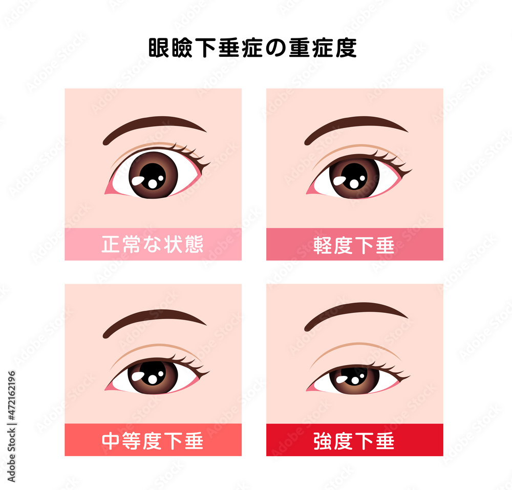 眼瞼下垂症の重症度比較 ベクターイラスト Stock Vector Adobe Stock 眼瞼下垂症の重症度比較 ベクターイラスト Stock Vector Adobe Stock