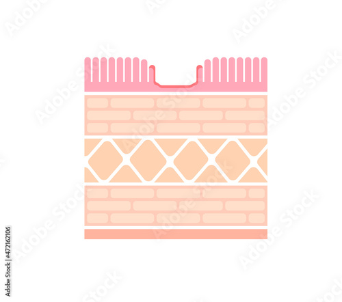 Sectional view illustration  of gastric erosion