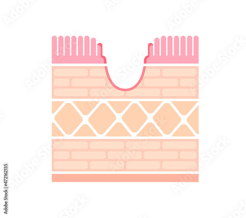 Sectional view illustration  of gastric ulcer