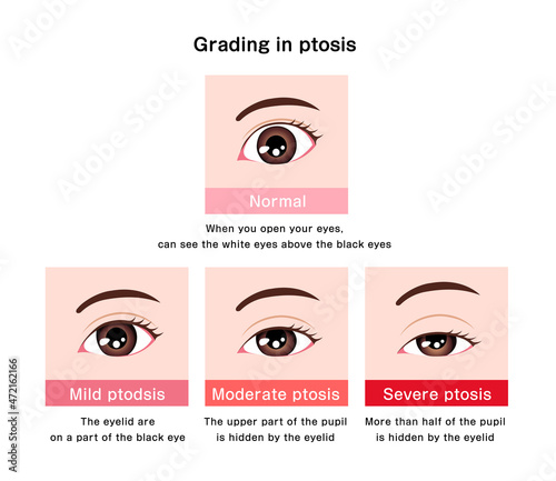 Grading in ptosis vector illustration