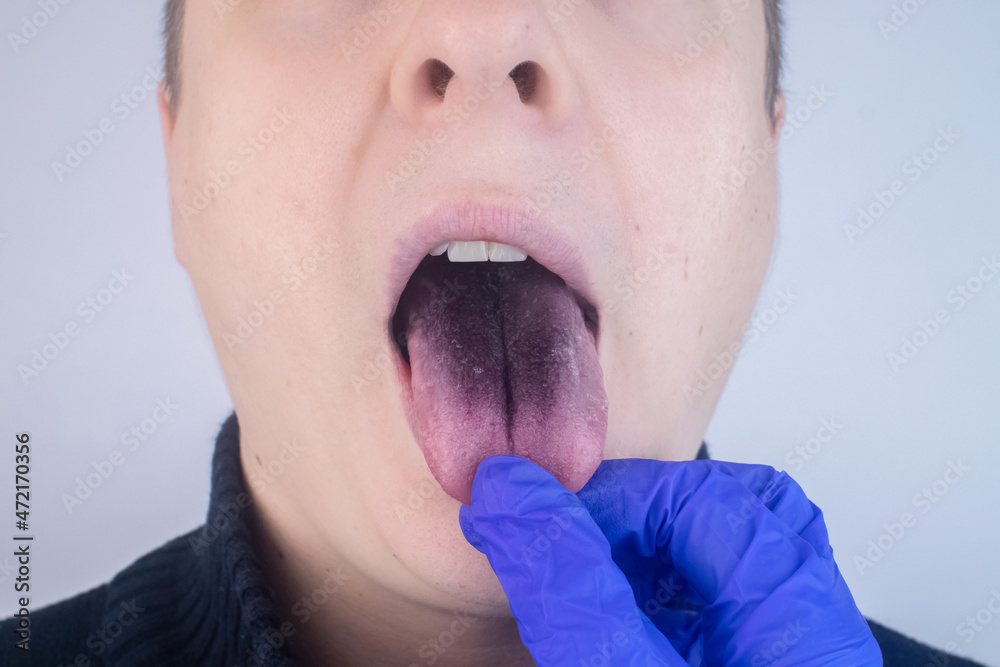 Fotka „Closeup of a man black tongue. Clinical manifestations of
