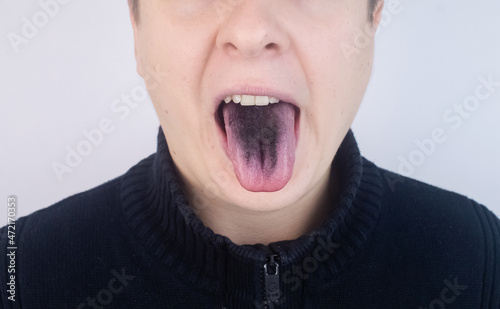 Close-up of a man black tongue. Clinical manifestations of lingua villosa. Bacterial infection of the mouth. The consequences of taking strong antibiotics. Fungal infection photo