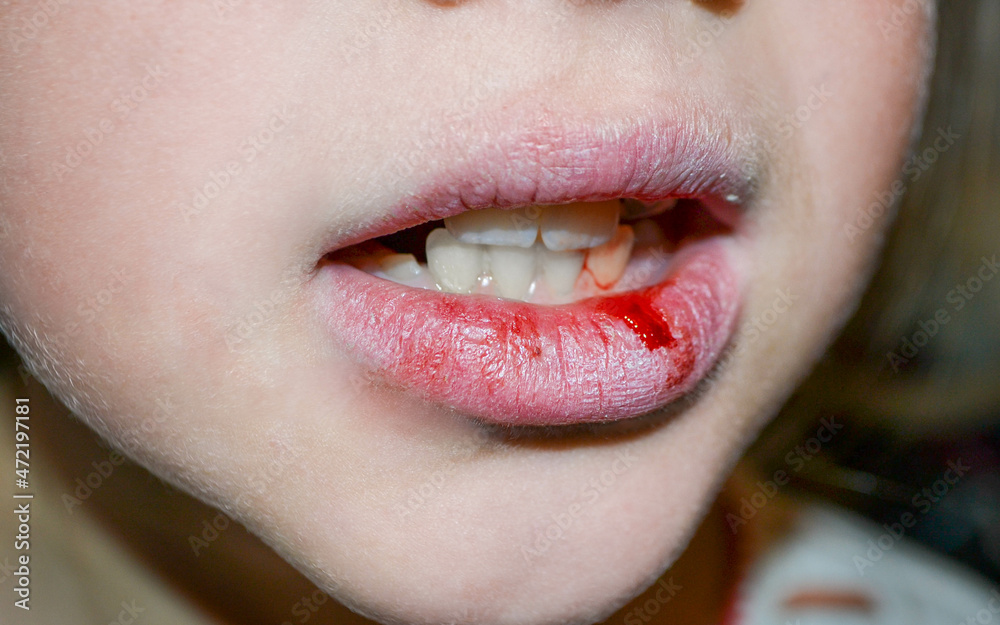 Foto Stock Dry and damaged lips of a girl. Closeup. Lip fissure and bleeding. Sick cracked