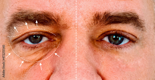 Compare man's eye before and after a blepharoplasty. Man aging problem eyes with wrinkle , big bag under eye and crow's feet in caucasian man middle age. photo