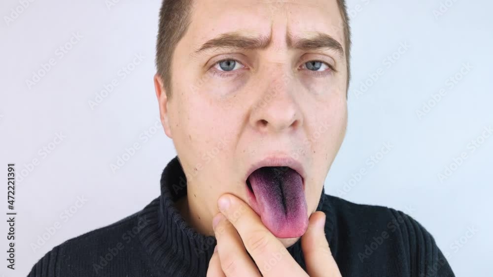 Closeup of a man black tongue. Clinical manifestations of lingua