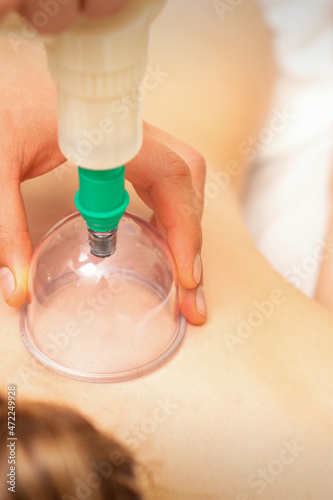 Woman receiving vacuum cupping treatment on back laying on the chest in massage salon
