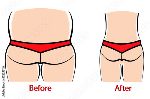 Hips slimming before and after vector illustration