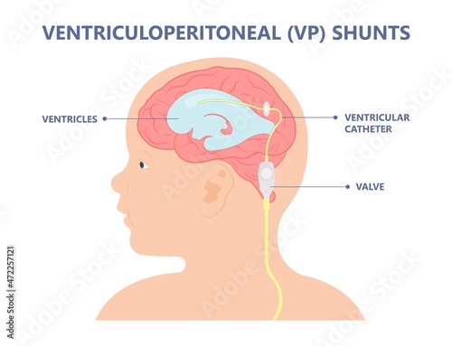 Hydrocephalus brain cerebrospinal fluid (CSF) drain head spina autism cerebral palsy myelomeningocele baby obstructive pediatric neurology birth defects