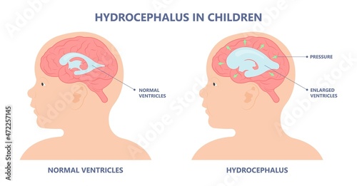 Hydrocephalus brain cerebrospinal fluid (CSF) drain head spina autism cerebral palsy myelomeningocele baby obstructive pediatric neurology birth defects