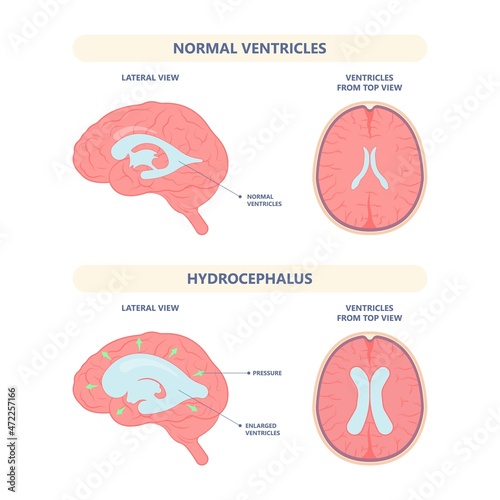 Hydrocephalus brain cerebrospinal fluid (CSF) drain head spina autism cerebral palsy myelomeningocele baby obstructive pediatric neurology birth defects photo