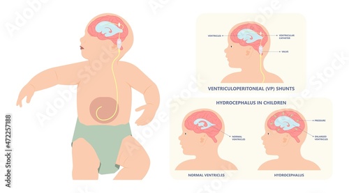 Hydrocephalus brain cerebrospinal fluid (CSF) drain head spina autism cerebral palsy myelomeningocele baby obstructive pediatric neurology birth defects photo