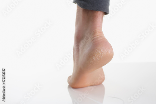 Single female leg or heel showing dried cracked heel with dried skin © H_Ko