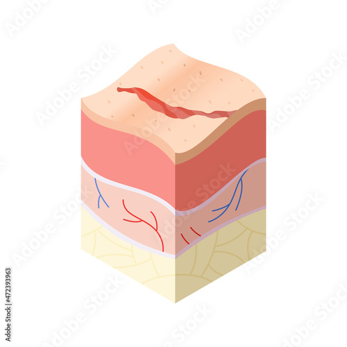 Skincare medical concept. Problems in cross-section of human skin horizontal layers structure. Anatomy illustrative model