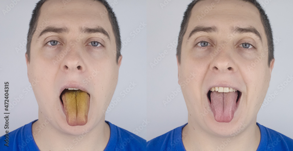 Before and after. Man has a yellow tongue. Painful yellow coating on