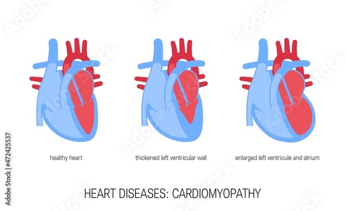 Heart diseases concept in flat style, vector