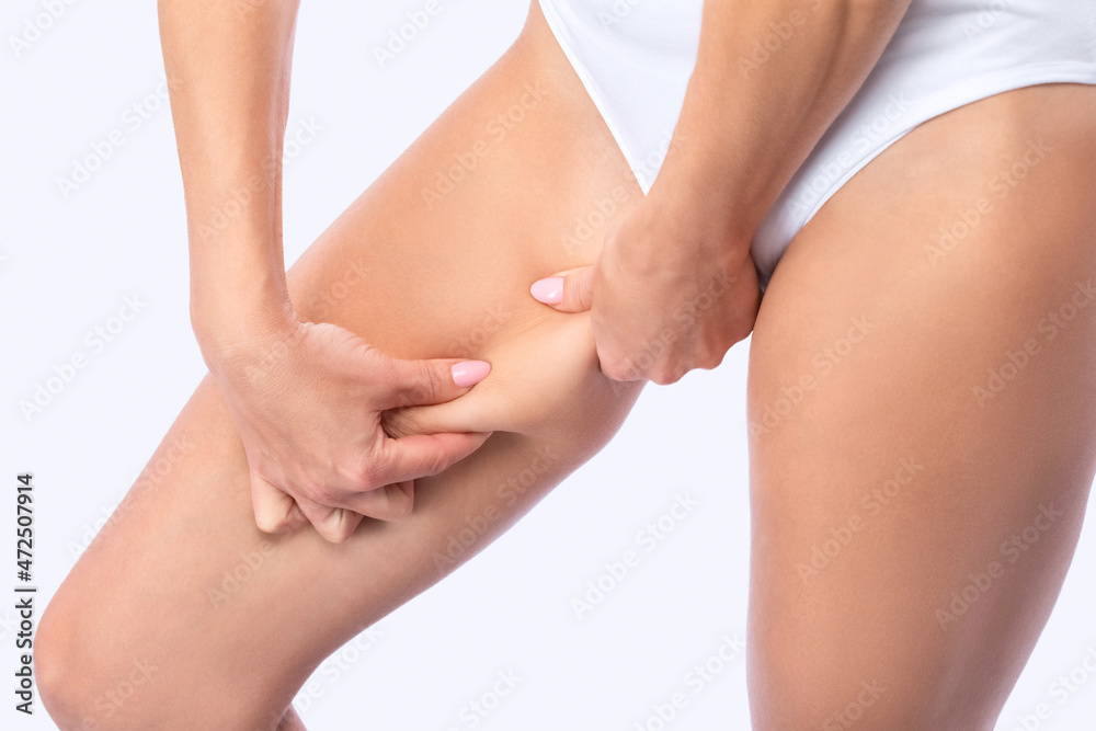 The girl stretches the skin on the leg, showing fat deposits. Treatment and getting rid of excess weight, the deposition of subcutaneous fat.