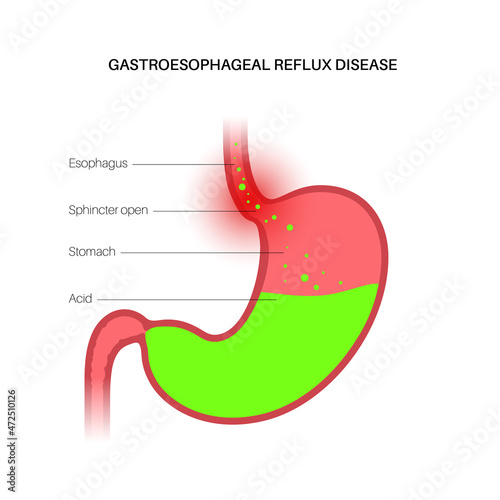 Gastroesophageal reflux disease