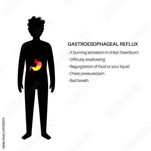 Gastroesophageal reflux disease